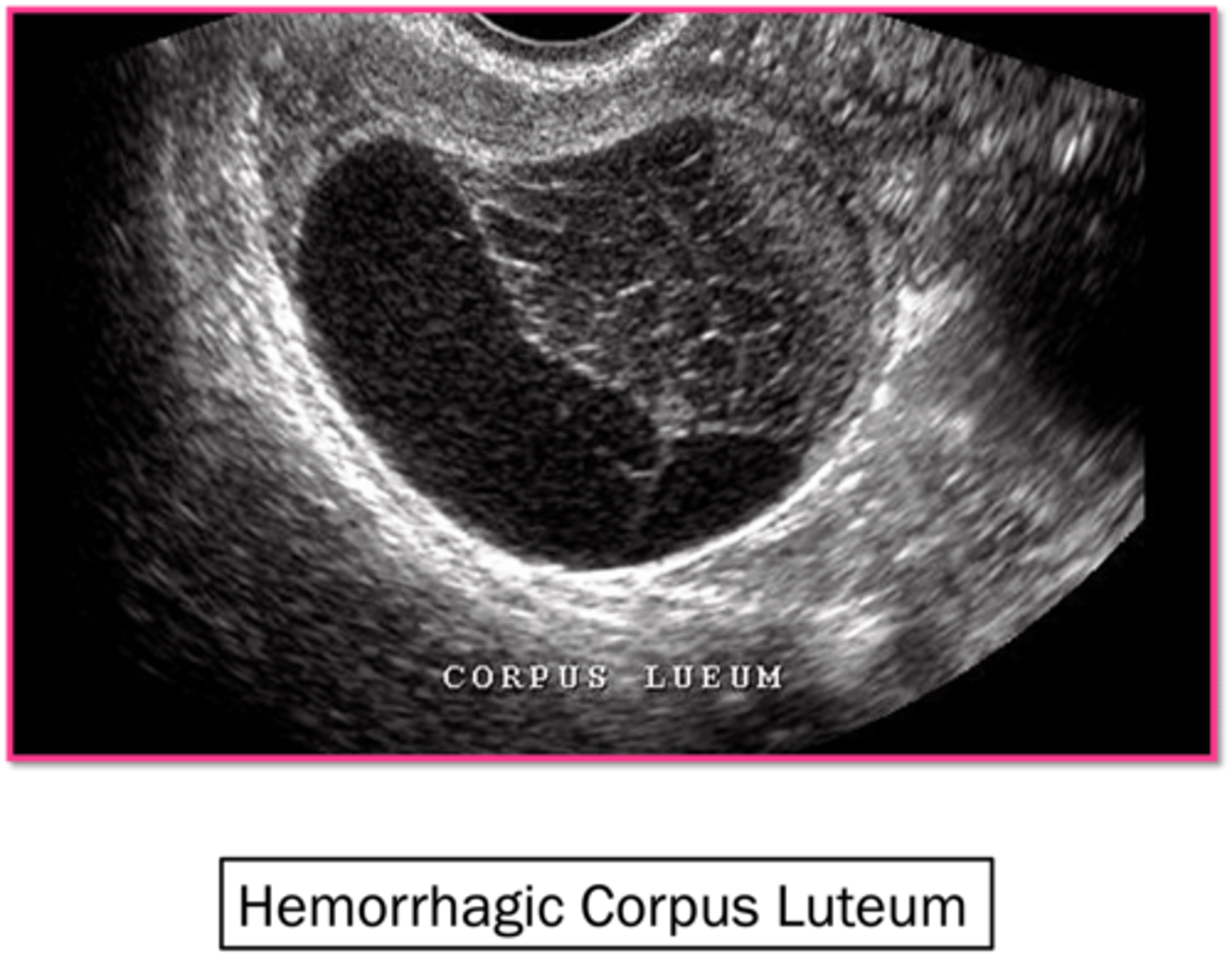 <p>hemorrhagic cysts</p>