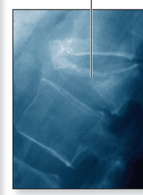 <p>What is a compression bone fracture?</p>
