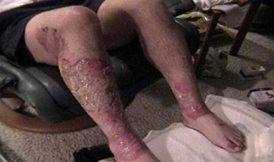 <p>2nd degree burn-Symptoms</p>