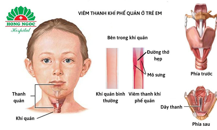 <p>Viêm thanh khí phế quản cấp (hay gặp ở trẻ nhỏ)</p>