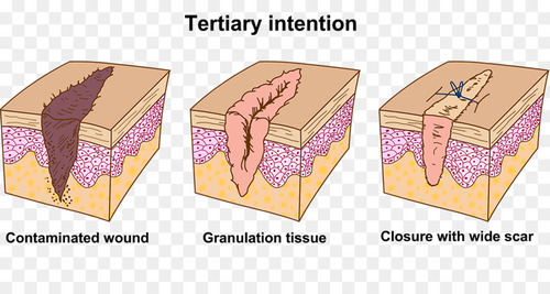 -time delay before wound is sutured
-greater granulation, greater risk for infection, greater inflammatory reaction than primary intention
-let the wound heal from the bottom to the top (leave wound open)


Would occur when the wound appears clean and there's evidence of good tissue vability and tissue perfusion