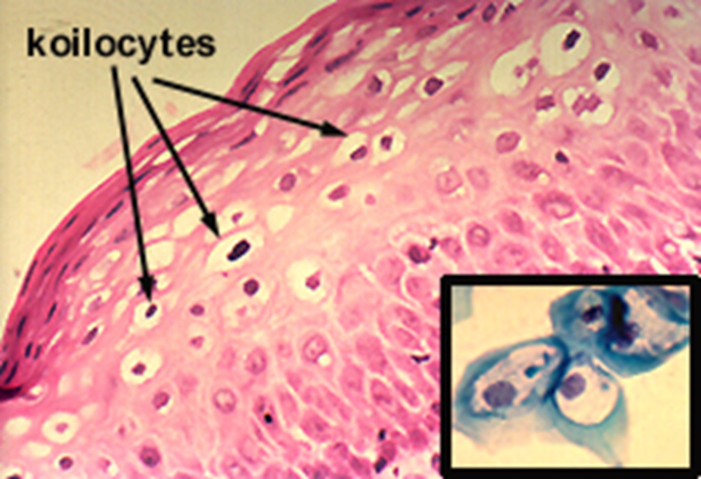 <p>Abnormal cells created by HPV infection that present with nuclear enlargement, irregularity of nuclear membrane contour (raisin-like), hyperchromasia (darker nucleus), and perinuclear halo (clear area around nucleus)</p>