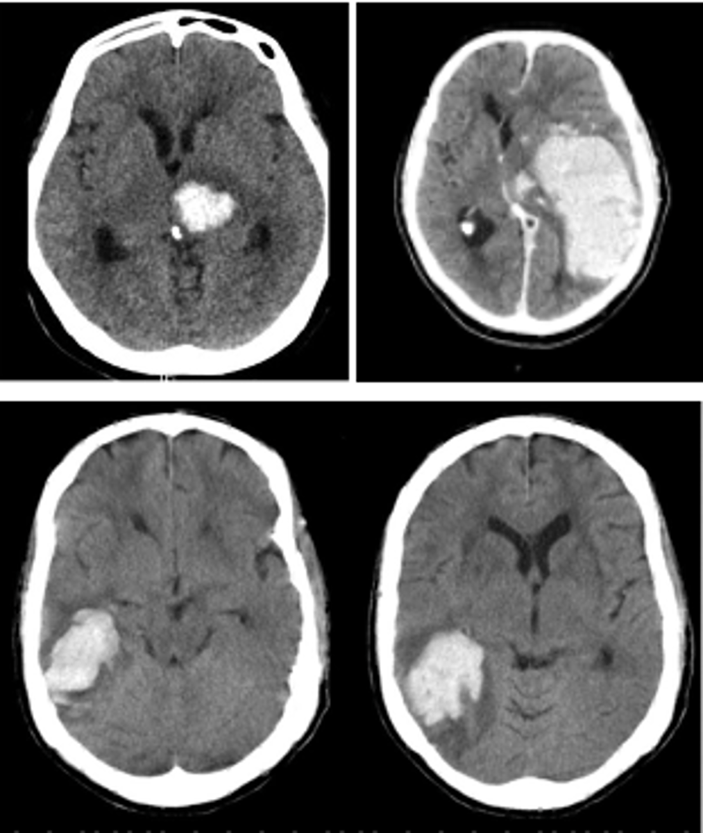 <p>SMASHU</p><p>Stroke - obeys vascular territory</p><p>Medication - anticoagulation or tacrolimus</p><p>Amyloid - older patients, lobar ICH</p><p>Systemic - malignancy, vasculitis, APLS</p><p>Hypertension - subcortical ICH (deeper vessels more susceptible)</p><p>Unknown</p>