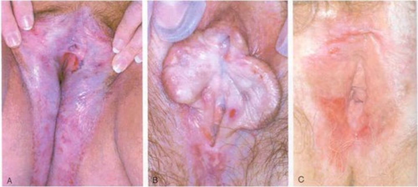 <p>lichen sclerosis: chronic mucocutaneous disorder that is characterized by inflammation, epithelial thinning, and depigmentation, and dermal changes-often include agglutination of labia minora, can be progressive or relapsing and remitting.</p><p>Most often genital, occasionally identified in other body areas, including trunk neck, forearms, axillae, and under the breasts, most often occurring on tissue that has undergone trauma</p><p>Dull, nonspecific vulvar irritation, whereas progressive disease often manifests with severe pruritus, burning, and associated dyspareunia; perianal symptoms, including pruritus ani, painful defecation, and anal fissures may also occur</p><p>Goals of tx: s/s relief, reversal of agglutination, prevention of further architectural distortion w/ loss of function, and prevention of potential malignant changes</p><p>First line tx - high or very high potency topical steroid ointment - clobetasol propionate 0.05%; 3 month tapered dosing common</p><p>Yearly vulvar exam</p><p>Atypical or nonresponsive to tx - referral to specialist</p>