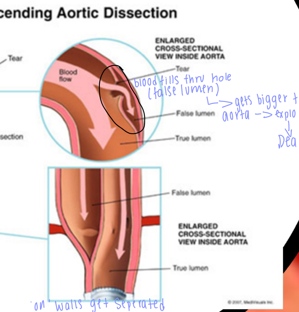 * blood pressure= systolic pressure-> systoli= highest number
* diastolic pressure-> lowest number
***** stiffining of arteries (age) = increase pressure-> damage walls
- aortic dissection (high blood pressure is the cause)= tunica intima breaks down, endothelium (simple squamous epithilium)  -> false lumen (hole in the wall) = starts to disect the tunica intima from the tunica media = false lumen gets filled with blood (ANYERISM) false lumen really big compressing real lumen (blood cant get through) POP! of false lumen= dead!
- symptoms: see pulsing of persons abdomin, chest pain, fatigue, indigestion

- solutions: put in a graph cavelar graph