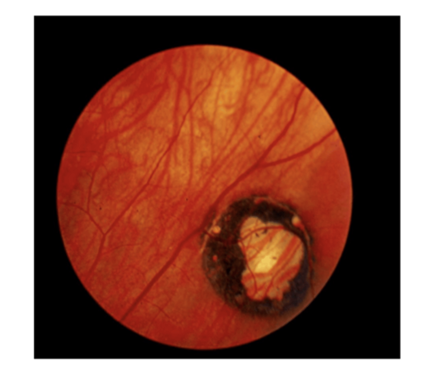 <p>Toxoplasmosis -- Chorioretinal Scar (Pic)</p>