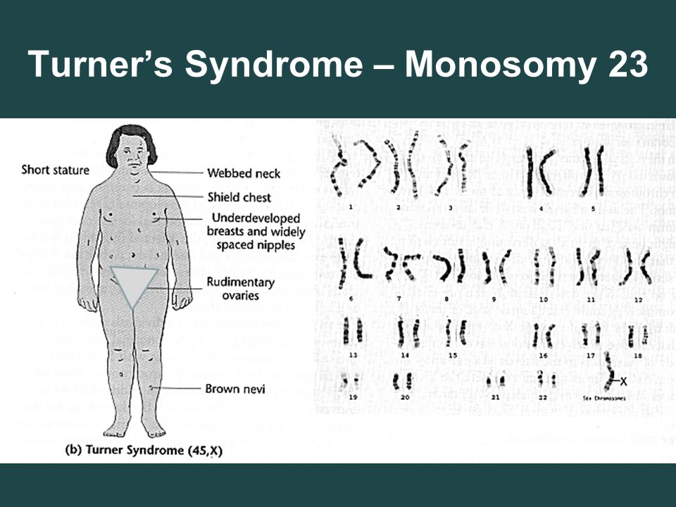 <p>Turner Syndrome…1 X…underdeveloped ovaries…females</p>