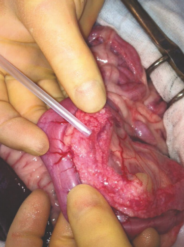 <p>Pancreas from a 5-yearold, spayed female, Domestic Short Hair cat. Clinical history: The cat presented with a history of anorexia, vomiting, and diarrhea. AFAST (an ultrasound technique) revealed peripancreatic free fluid. Spec fPLI yielded a positive test result (feline pancreatic lipase immunoreactivity &gt;5.4 g/L). Morphological diagnosis?</p>