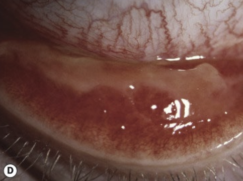 <ul><li><p>Pseudomembrane: coagulated exudate that adheres to the inflamed conj epithelium. Can peel without bleeding</p></li><li><p>Membrane: coagulated exudate that adheres to the inflamed conj. Contains more fibrin and blood vessels. Bleeding will occur if pull membrane away.&nbsp;</p></li></ul><p></p>