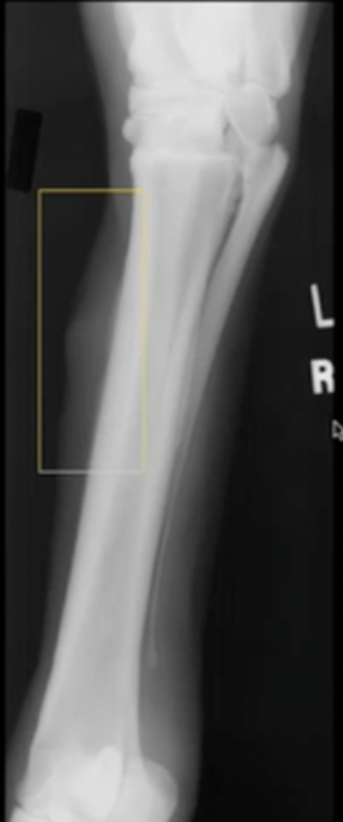 <p>What type of new bone formation is this?</p>