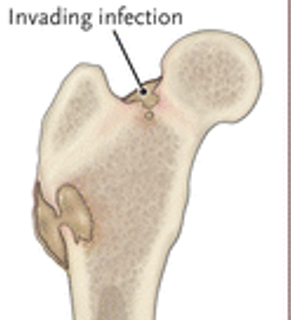 <p>it is an infection of the bone</p>