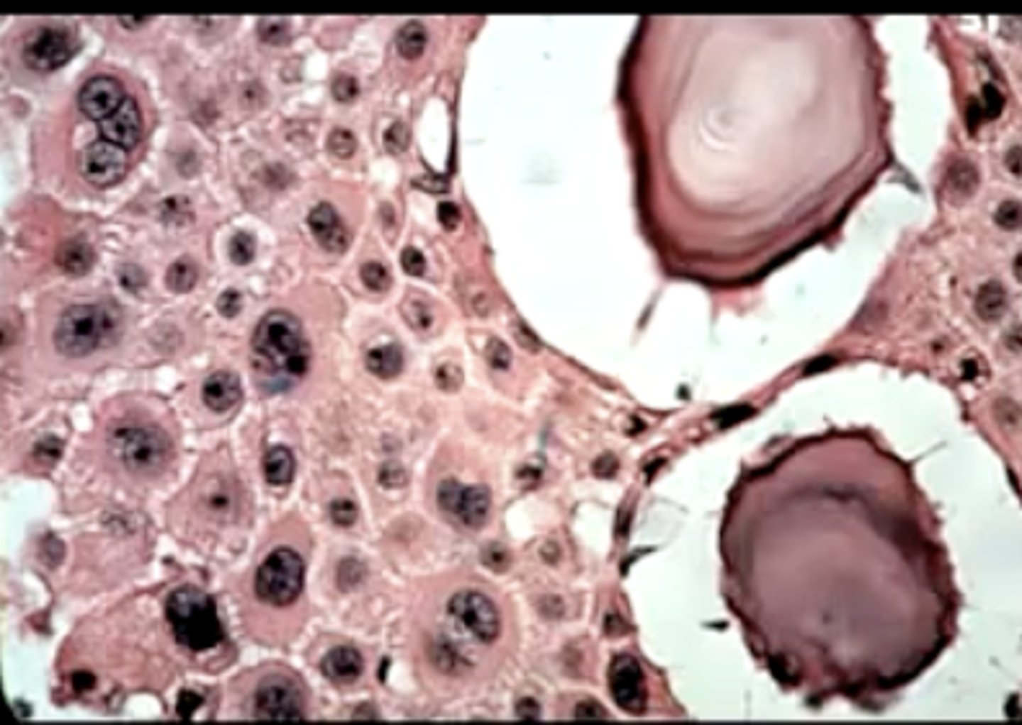 <p>variable presentation, but there are Liesegang ring calcifications and amyloid </p><p>prob will be on exam</p>