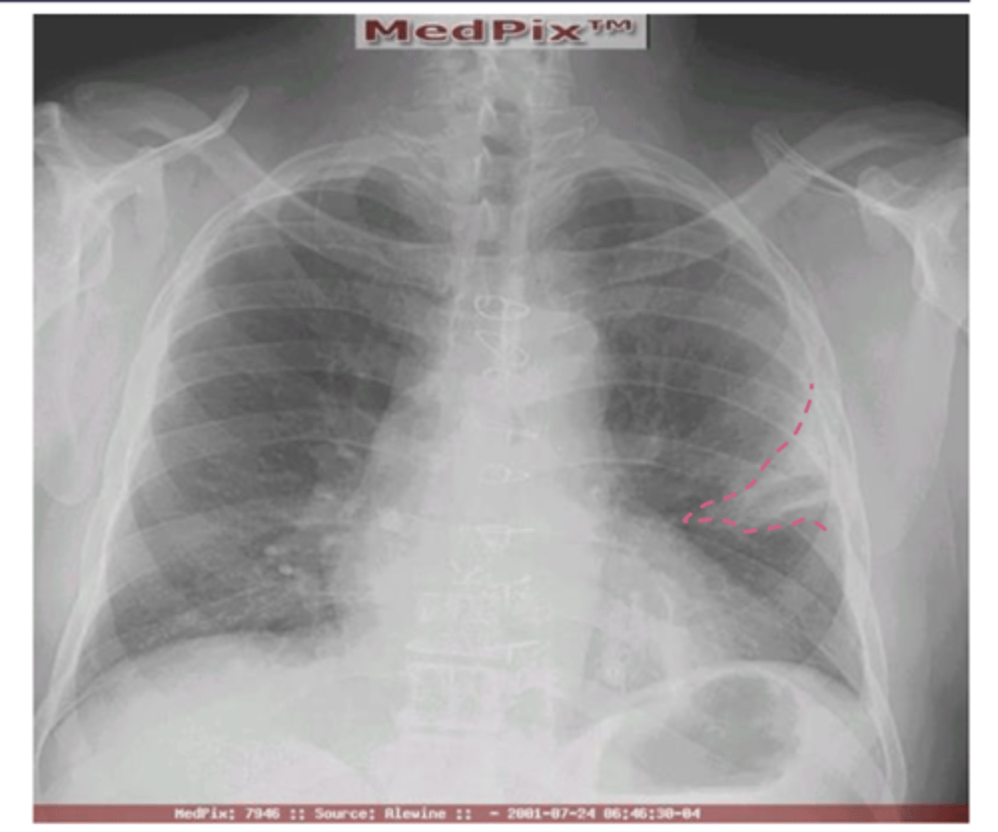 <p>Wedge shaped pleural based opacity --&gt; indicative of pulmonary embolism</p>