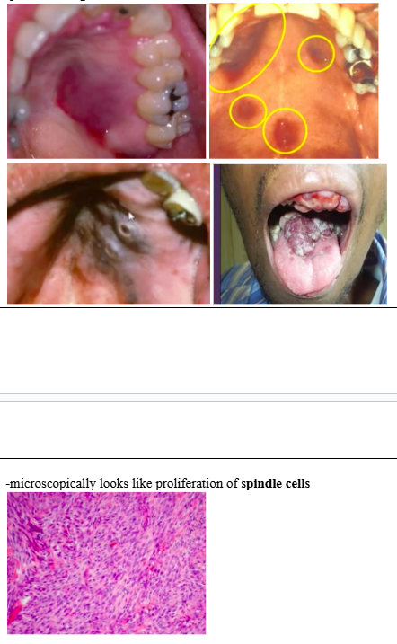 <p><span style="background-color: transparent; font-family: &quot;Times New Roman&quot;, serif;">-multifocal <strong>endothelial cell neoplasm</strong> of skin or oral mucosa (<strong>HHV-8</strong>)&nbsp;</span></p><p><span style="background-color: transparent; font-family: &quot;Times New Roman&quot;, serif;">-skin: trunk, arms, H and N</span></p><p><span style="background-color: transparent; font-family: &quot;Times New Roman&quot;, serif;">-oral cavity: hard palate, gingiva, tongue&nbsp;</span></p><p><span style="background-color: transparent; font-family: &quot;Times New Roman&quot;, serif;">-lesions: brown/red/purple flat patch -&gt; plaques -&gt; nodules&nbsp;</span></p><p><span style="background-color: transparent; font-family: &quot;Times New Roman&quot;, serif;">-pain, bleeding, necrosis necessitates tx</span></p><p></p><p><span style="background-color: transparent; font-family: &quot;Times New Roman&quot;, serif;">-microscopically looks like proliferation of <strong>spindle cells</strong></span></p>