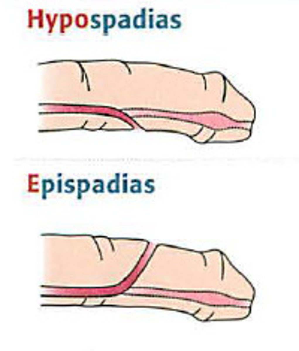 <p>epispadias → assoc with bladder exstrophy</p>