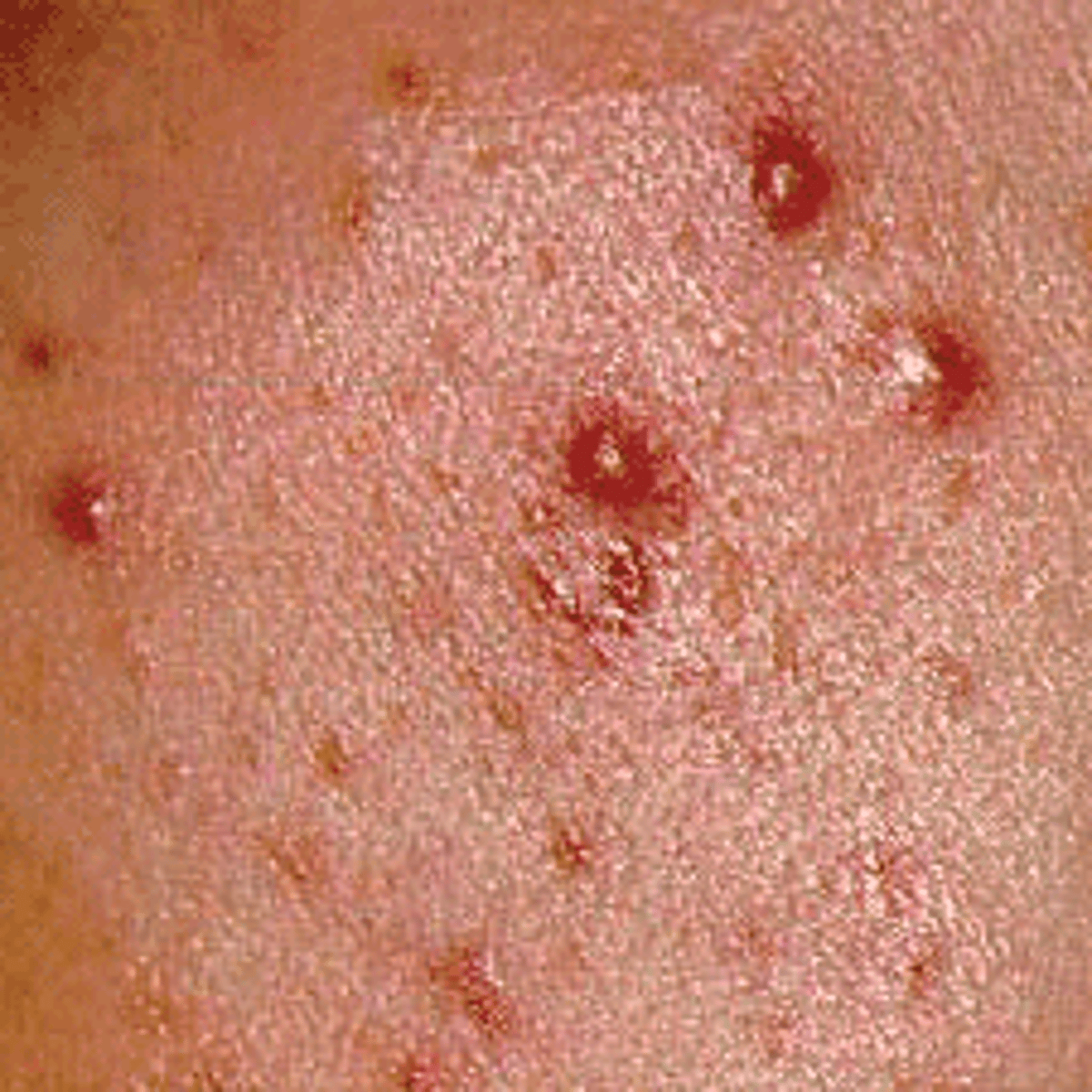 <p>Something you can feel (i.e., solid, elevated, circumscribed, less than 1 cm diameter) caused by superficial thickening in epidermis. Examples: mole and wart.</p>