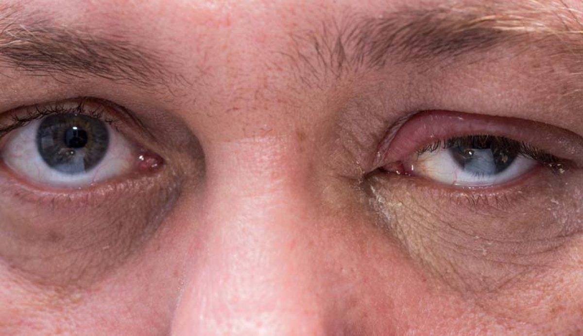 <p>Lesão no bolbo raquidiano → SNS olho</p><ul><li><p>miose</p></li><li><p>ptose (+ discreta)</p></li></ul><p></p>