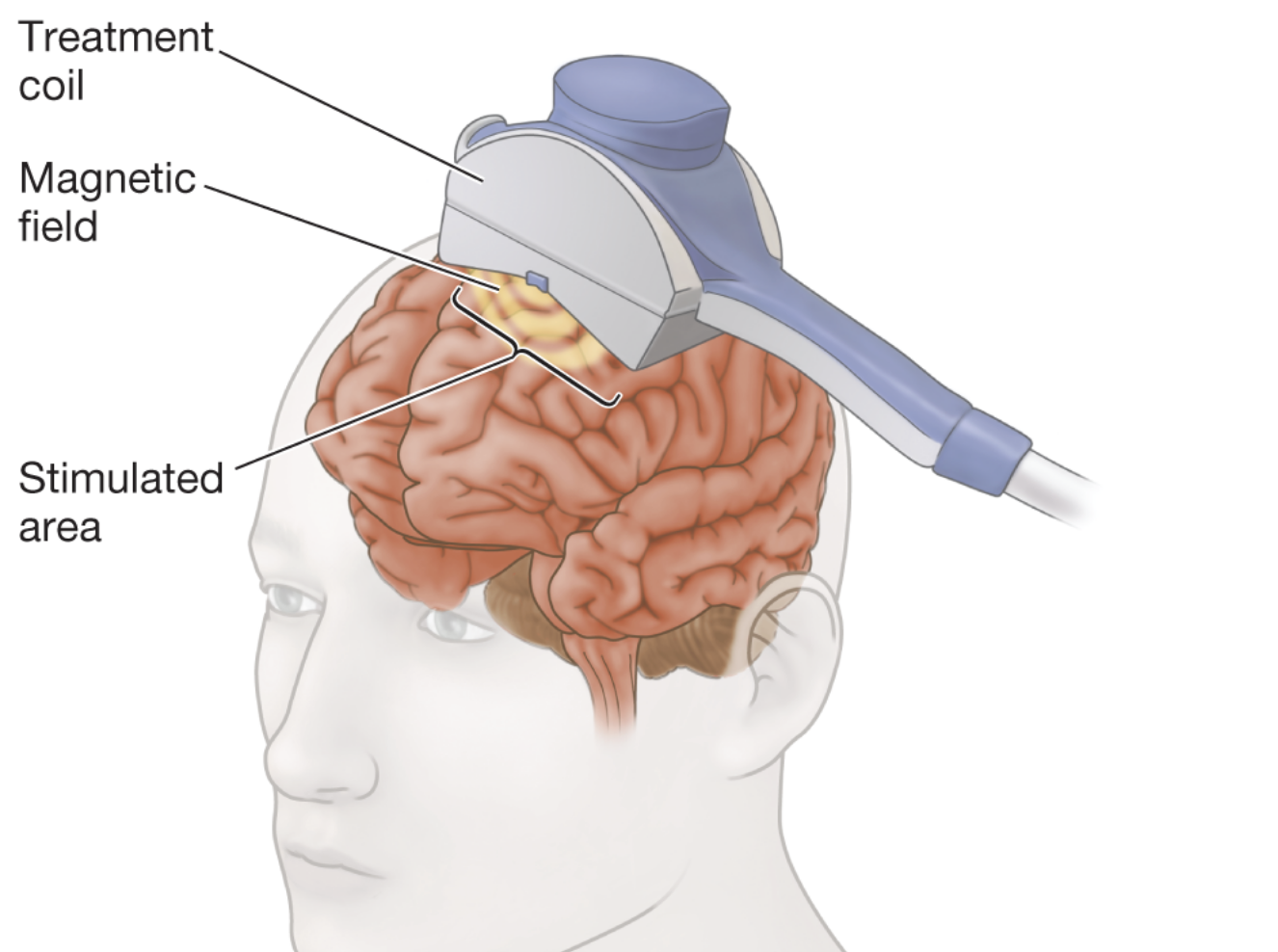 <ul><li><p>used to treat severe depression</p></li><li><p>interrupts neural function in that region</p></li></ul><p></p>