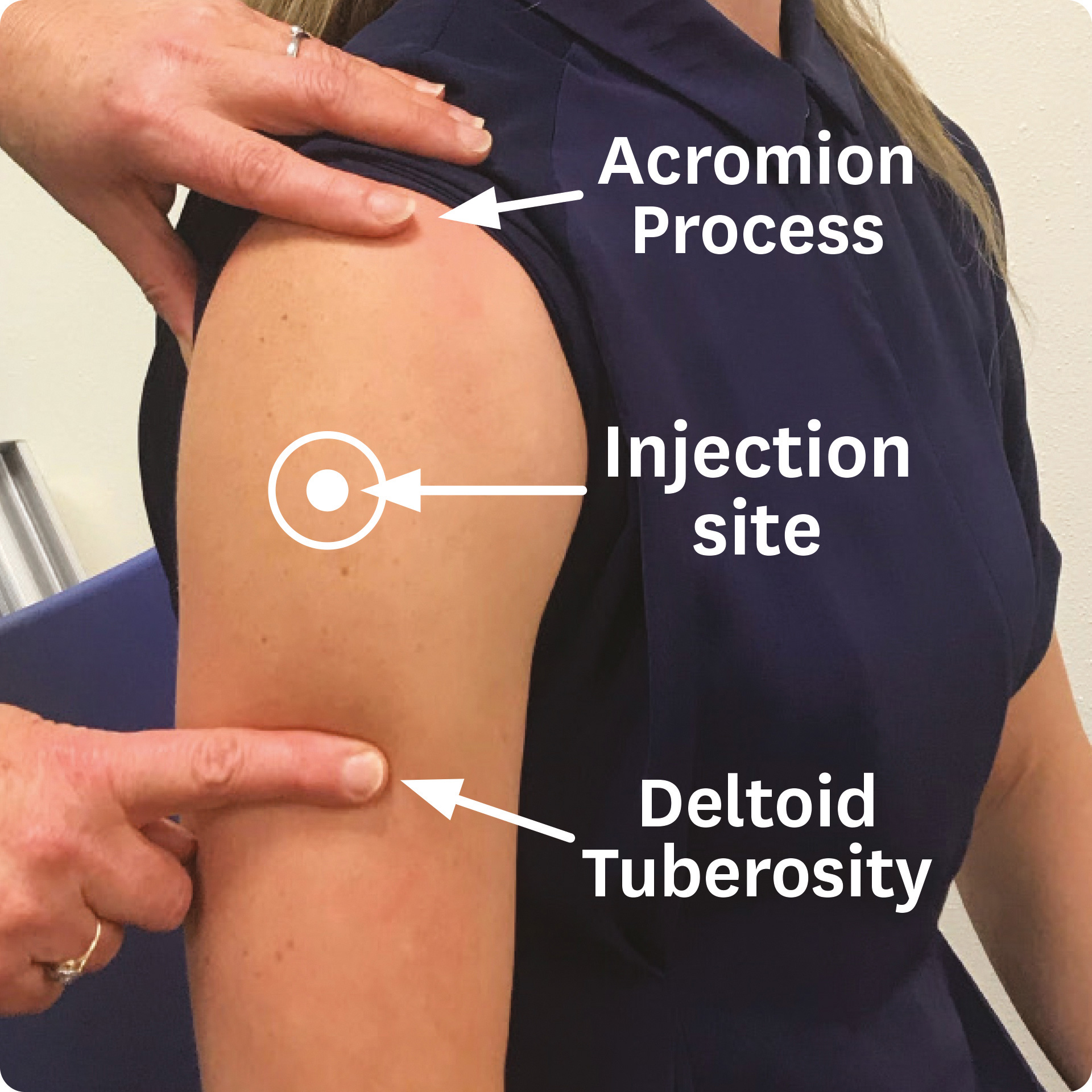 <p>IM site. Palpate the acromion process. Injection site is 2-3 finger-widths below the acromion process but above deltoid groove. 1mL or less. </p>