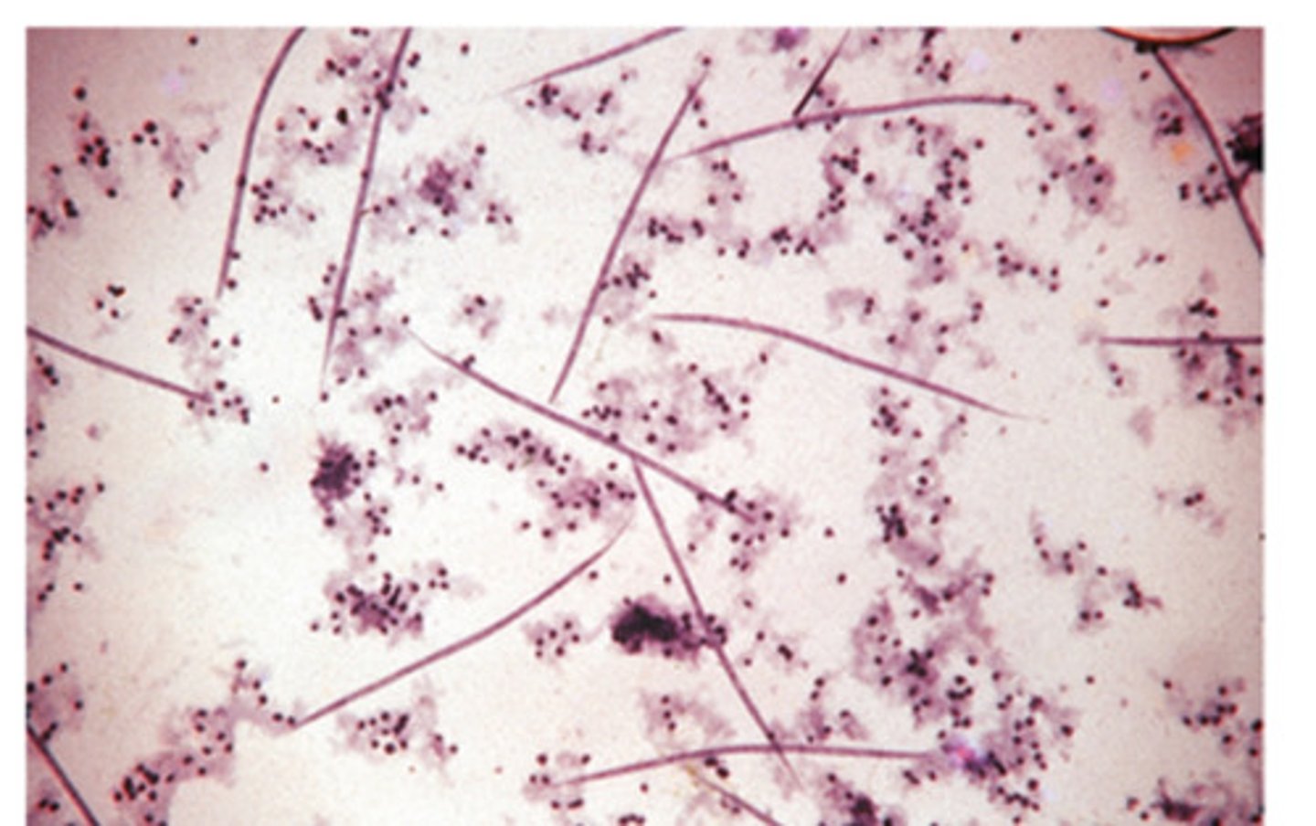 <p>Dirofilaria immitis, the canine heartworm, can be identified by finding the microfilariae on a modified knott's test. Dirofilaria immitis microfilariae must be differentiated from the microfilariae of __</p>