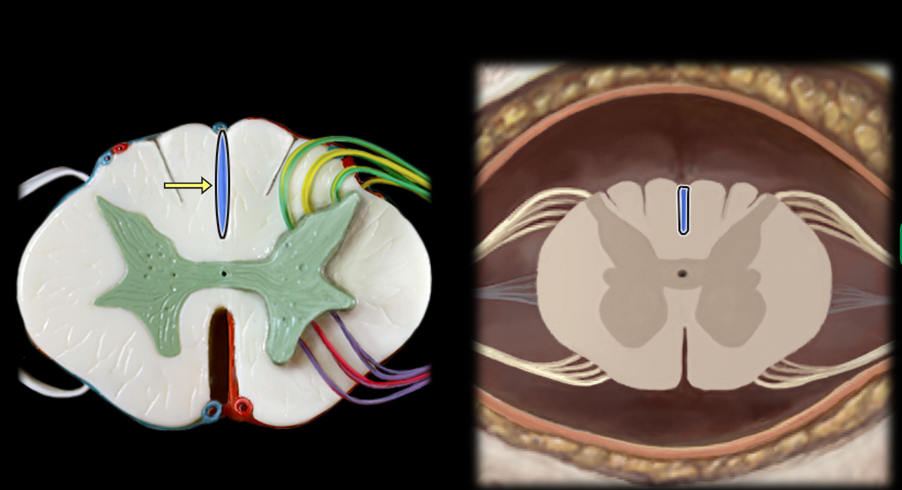 <p>Dorsal median sulcus</p>