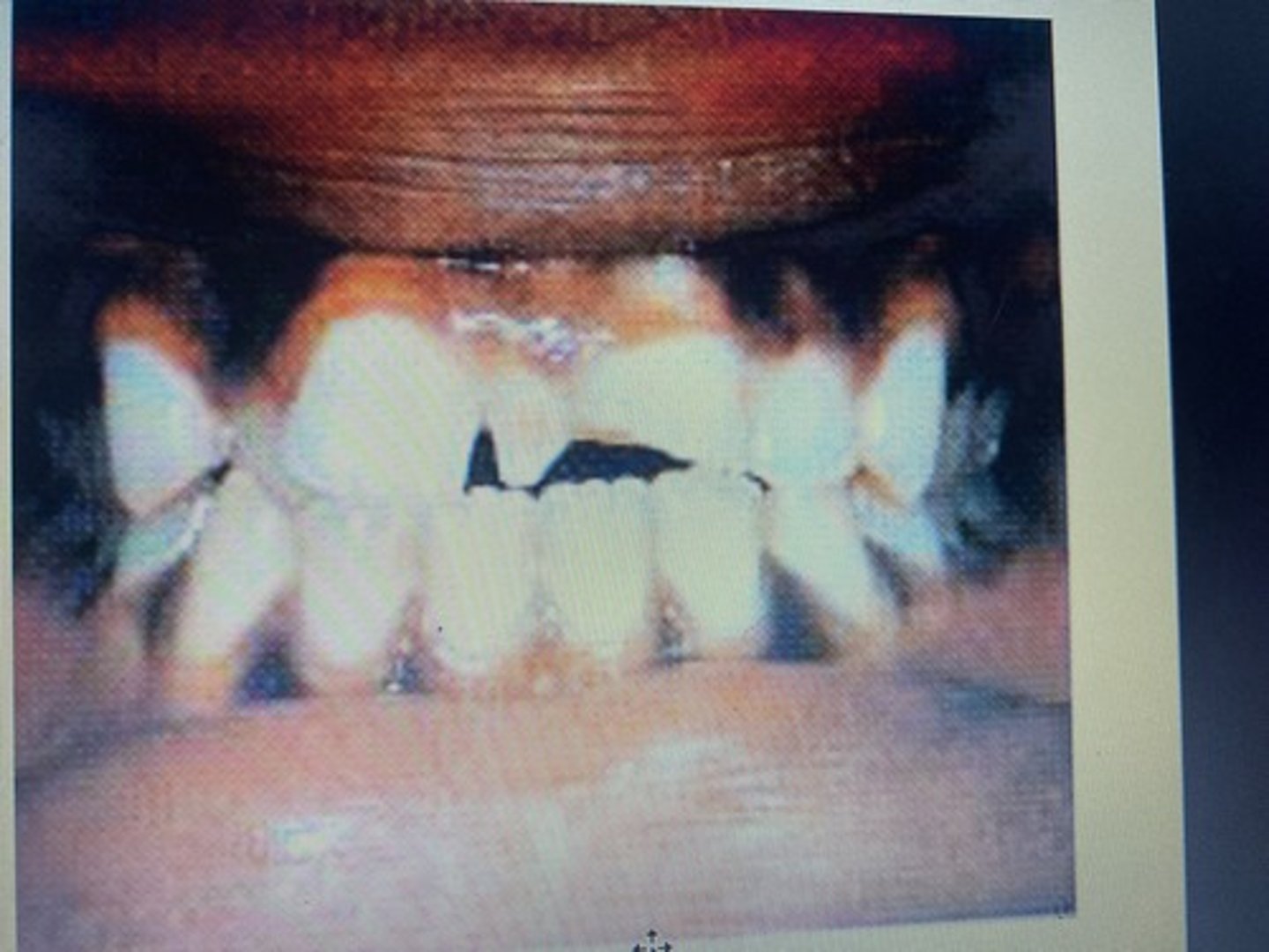 <p>The most common supernumerary tooth.</p><p>Always interproximal of tooth 8 and 9.</p>
