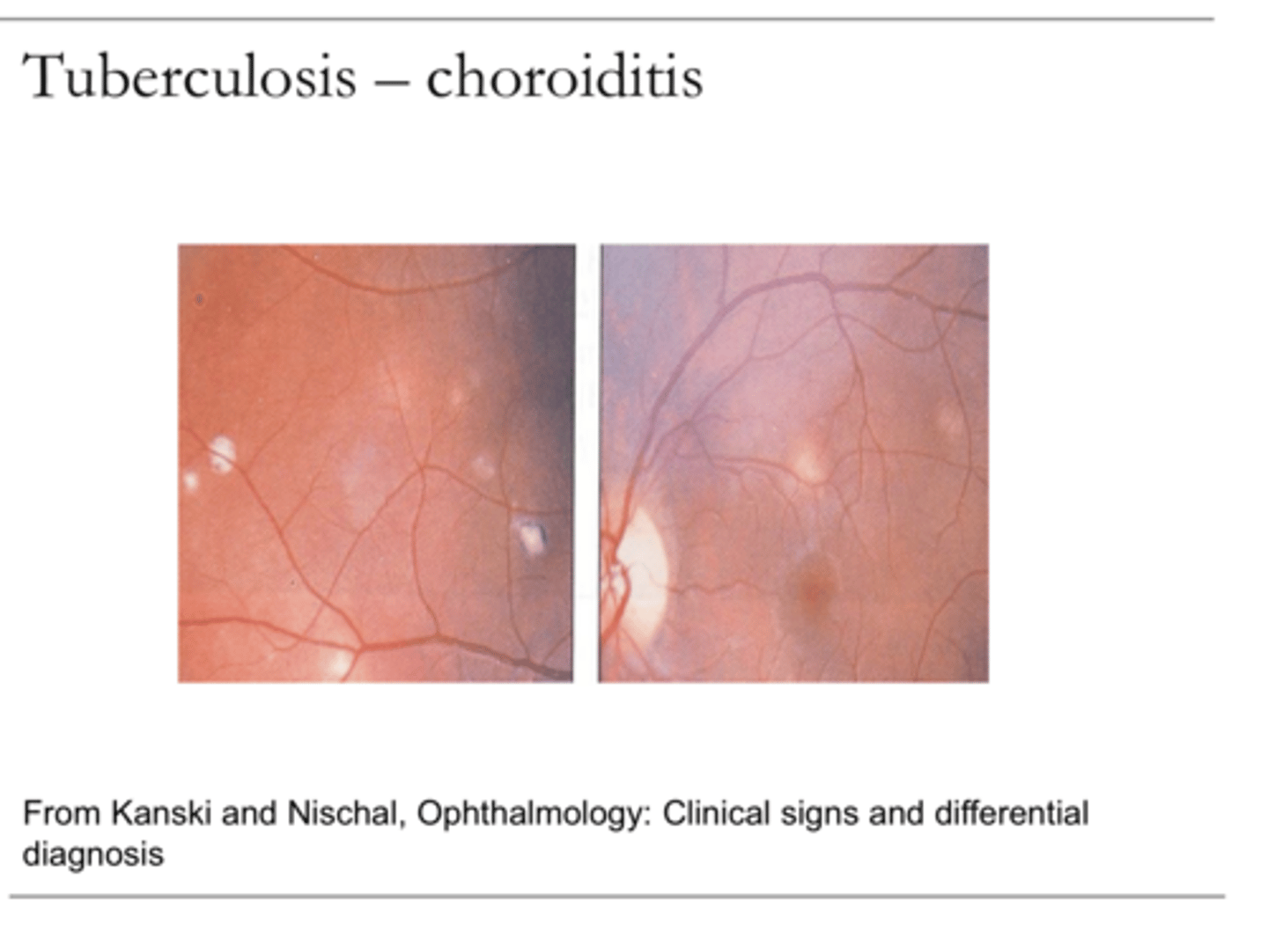 <p>Choroiditis -- Tuberculosis (Pic)</p>