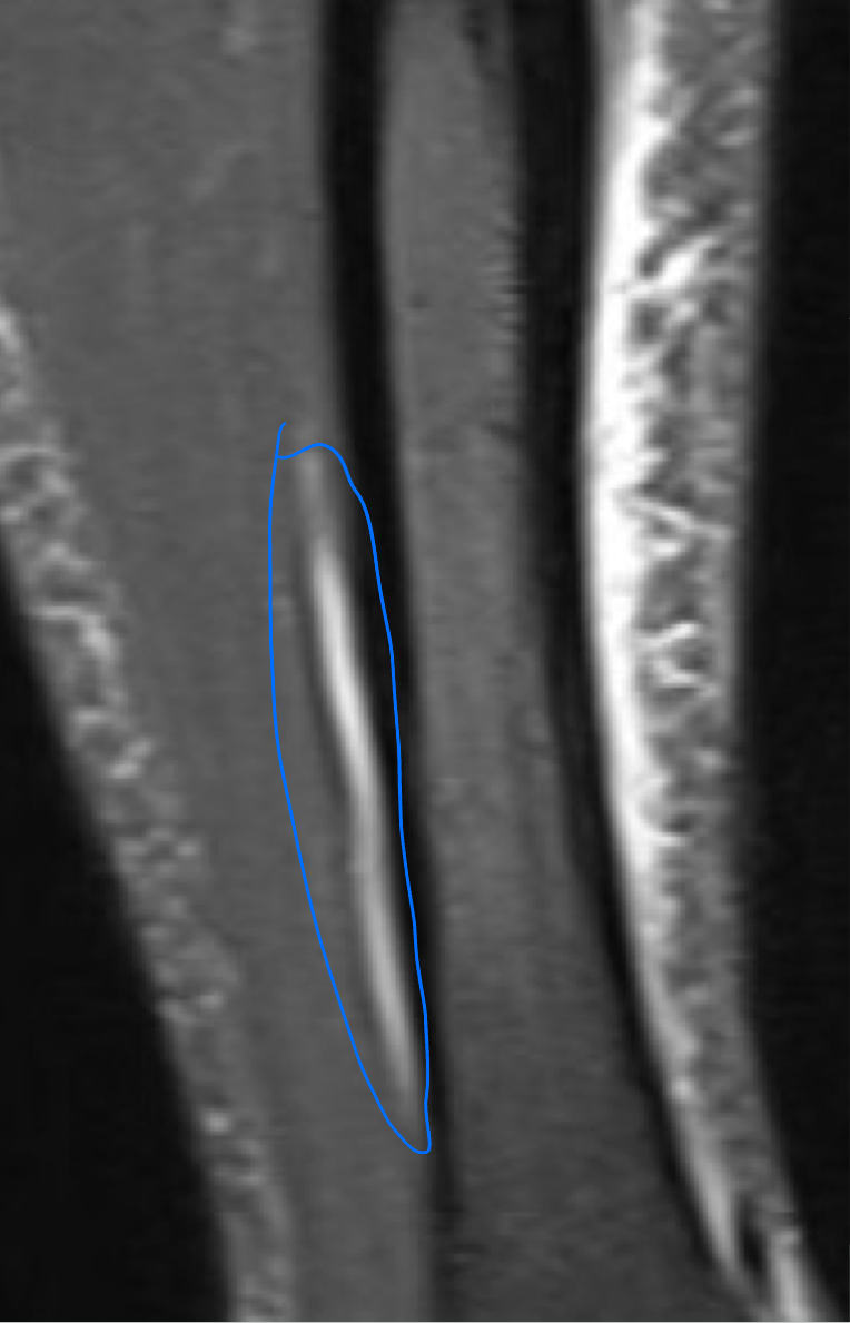 <p>Coronal STIR (fat signal suppressed) MRI of a lower leg showing high signal (bright) areas around the tibia as signs of stress fracture</p>