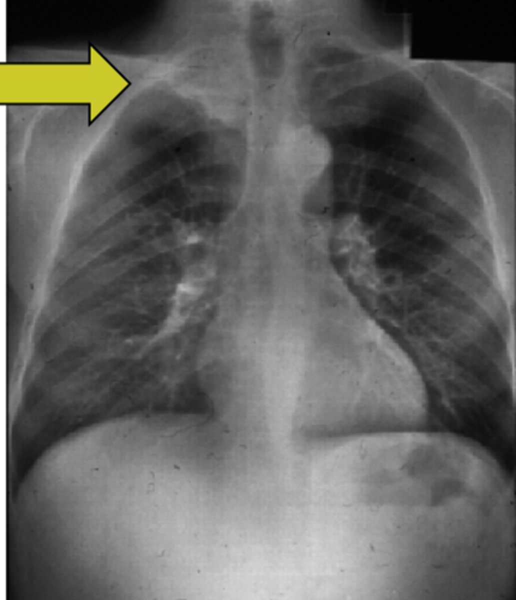 <p>pancoast tumor (non-small cell tumor of the superior sulcus) <br>-tumor often presses on brachial plexus--&gt; pain and sensory loss of shoulder/arm<br><br>-may also see patients with this cancer who have hoarse voice from tumor pushing on laryngeal nerve</p>