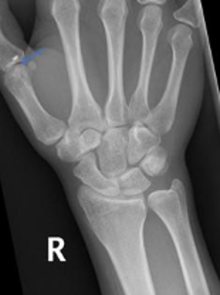 <p>What joint space are the arrows pointing to</p>