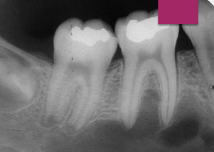 <p>What is the cause of Traumatic Bone Cyst (TBC)?</p>