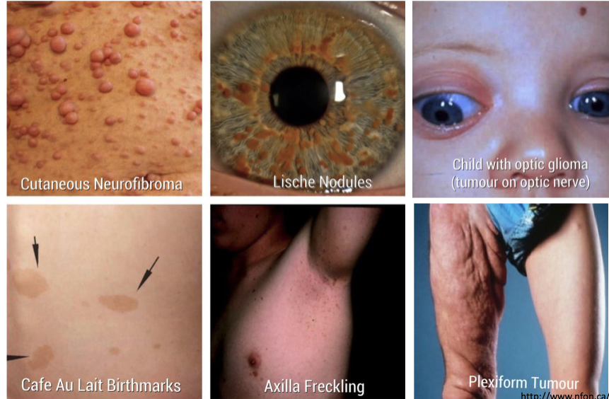 <ol><li><p>café au lait macules</p></li><li><p>axilla freckling </p></li><li><p>cutaneous neurofibroma</p></li><li><p>lische nodules </p></li><li><p>optic glioma</p></li><li><p>plexiform tumor </p></li></ol><p></p>