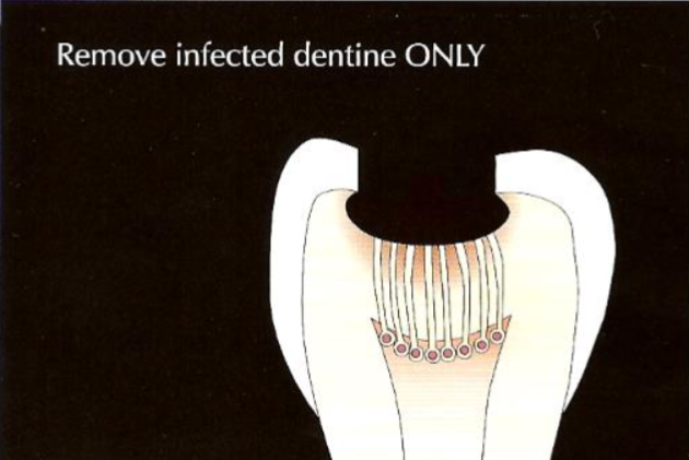 <p>remove infected dentine </p><p>leave affected dentine </p>