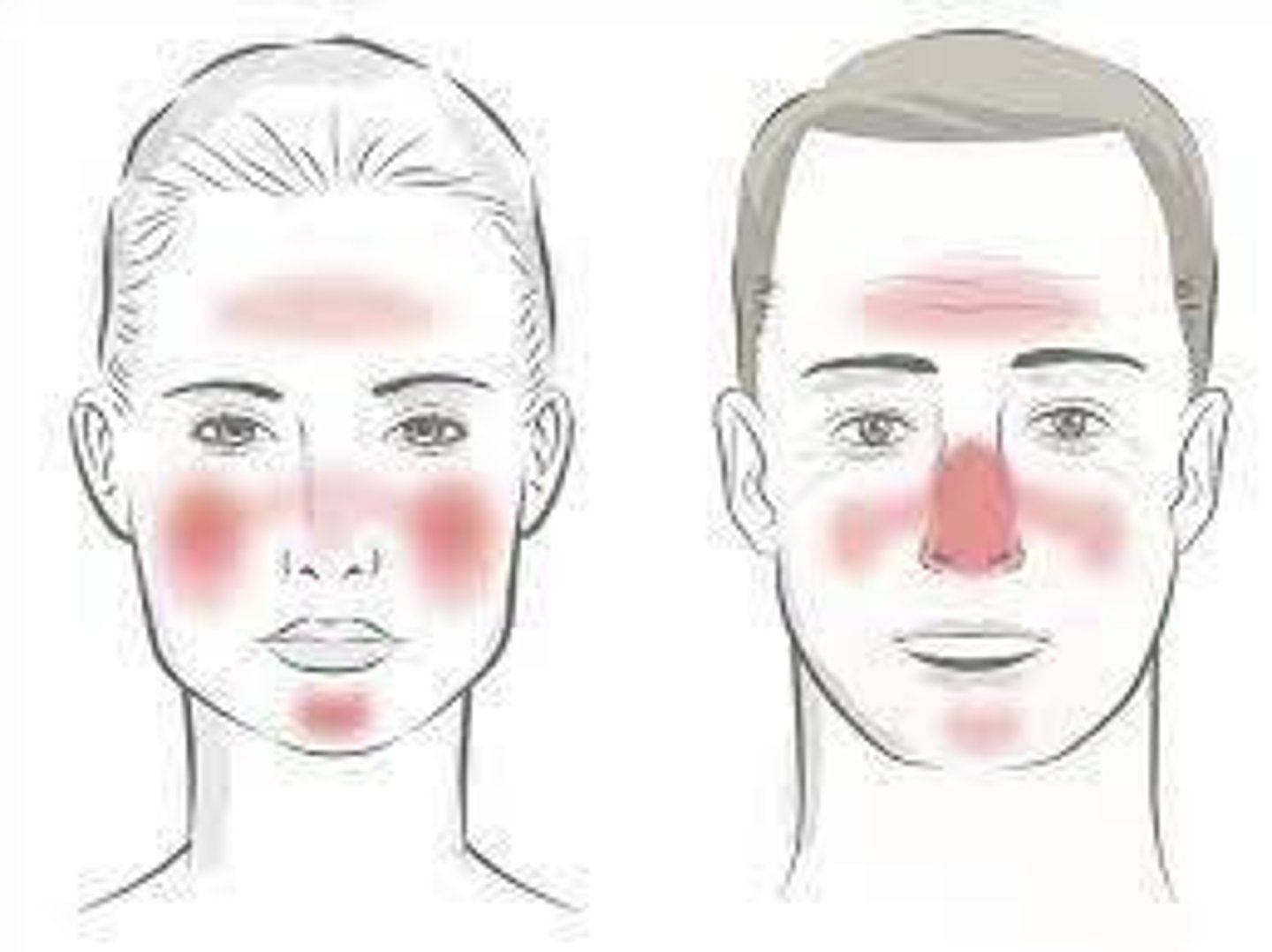 <p>Redness and visible blood vessels in the face, can lead to acne and ocular symptoms.</p>