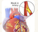 <p>necrosis due to thrombosis or embolim</p>