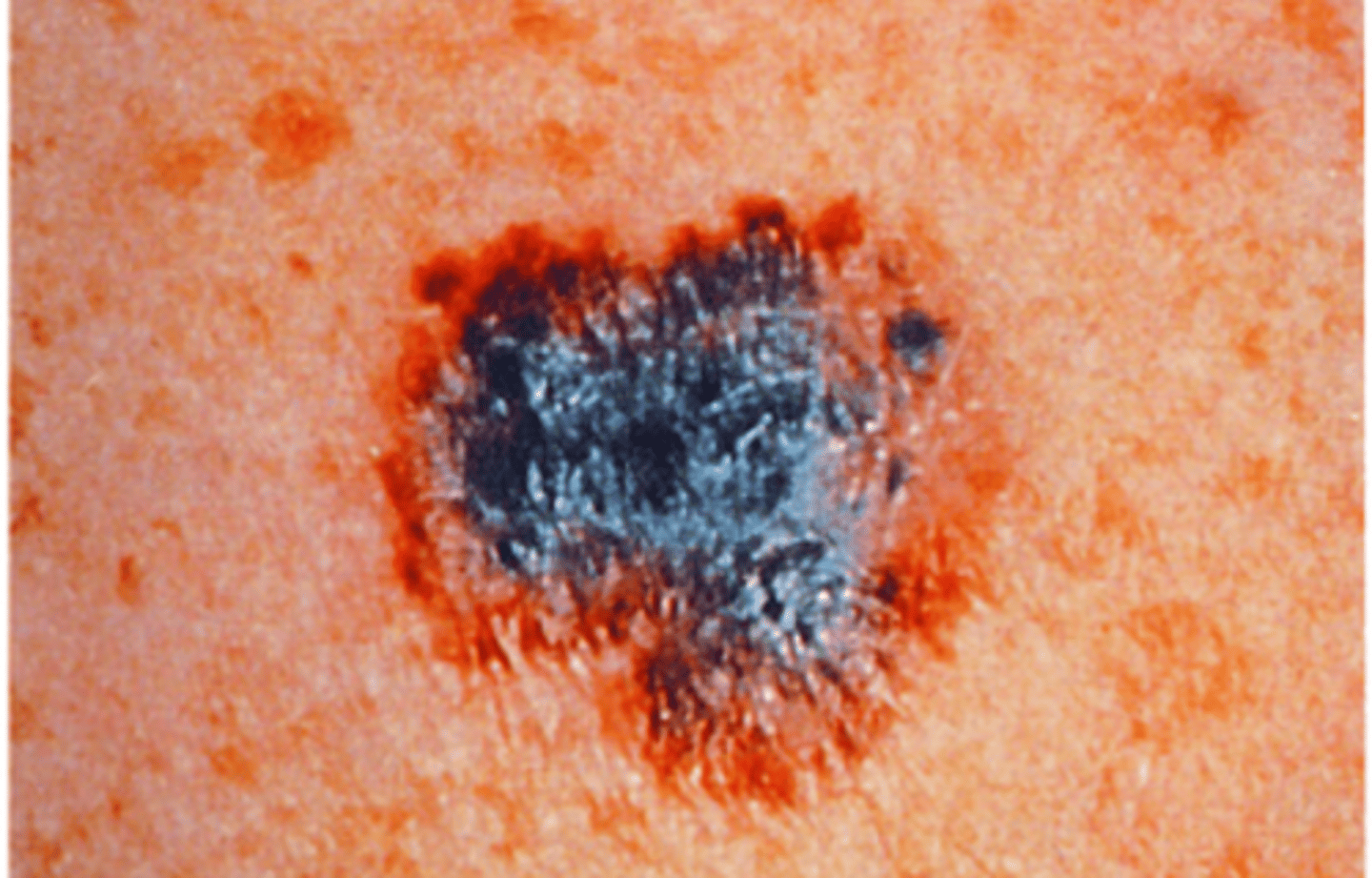 <p>-Most serious form of skin cancer</p><p>-Use ABCDEF evaluation</p><p>-20x higher in Whites than African Americans, 4x higher in Hispanics</p><p>-More than 6mm</p><p>-More than two abnormal lesion characteristics</p>