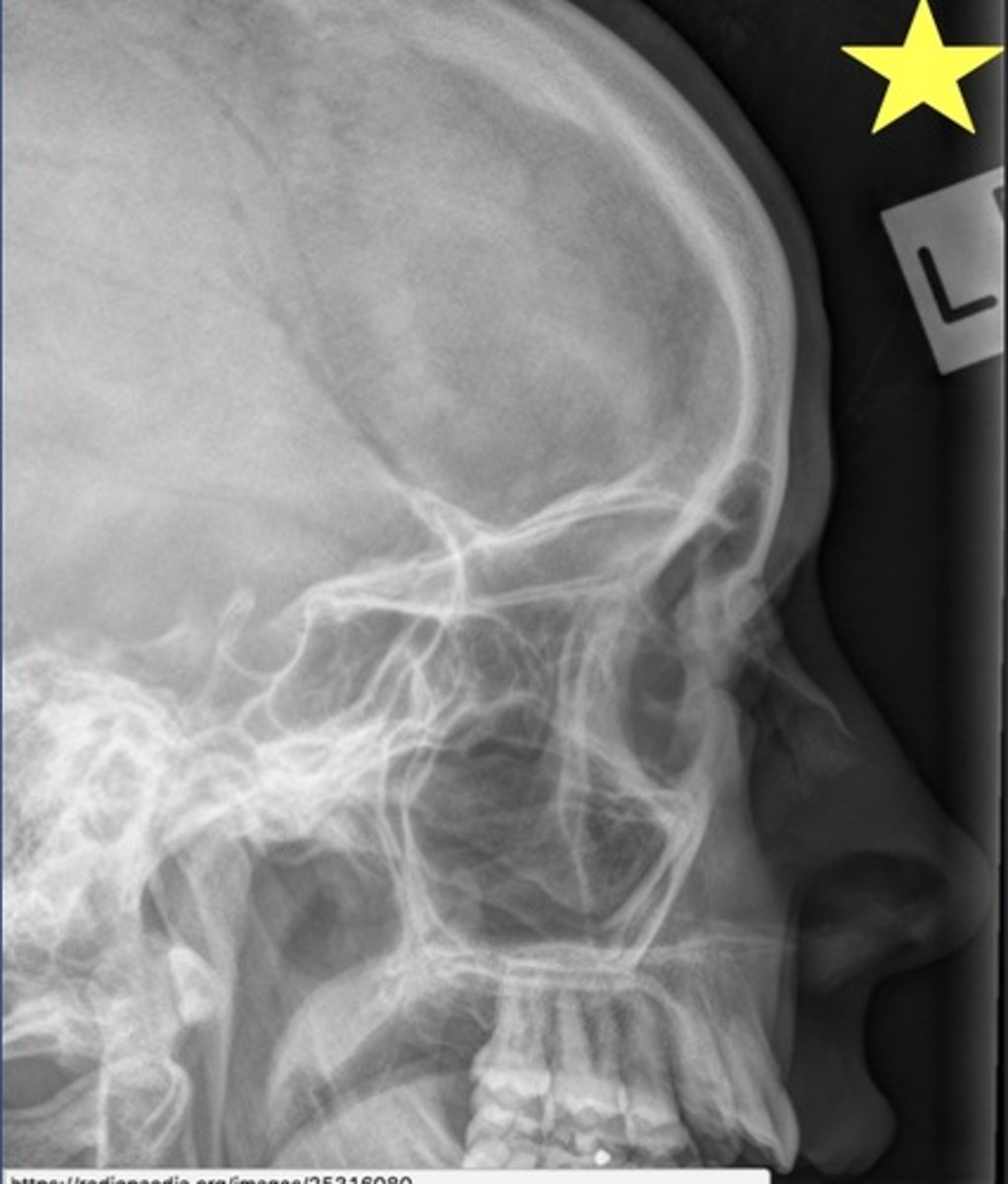 <p>What view was this radiograph shot in? Ensure you can locate the sinuses.</p>