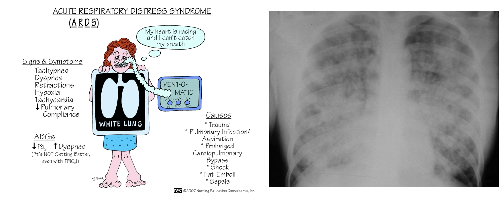 <p>Patient experience one of the causative factors →</p><p>SEVERE DYSPNEA WITH <strong>RAPID ONSET </strong>(less than 7 days) →</p><p><strong>SUPPLEMENTAL O2 INCREASES FO NOT IMRPOVE BREATHING </strong>→</p><p>Hypoxia, tachypnea, tachycardia (compensation) →</p><p>Bilateral infiltration of CXR</p>
