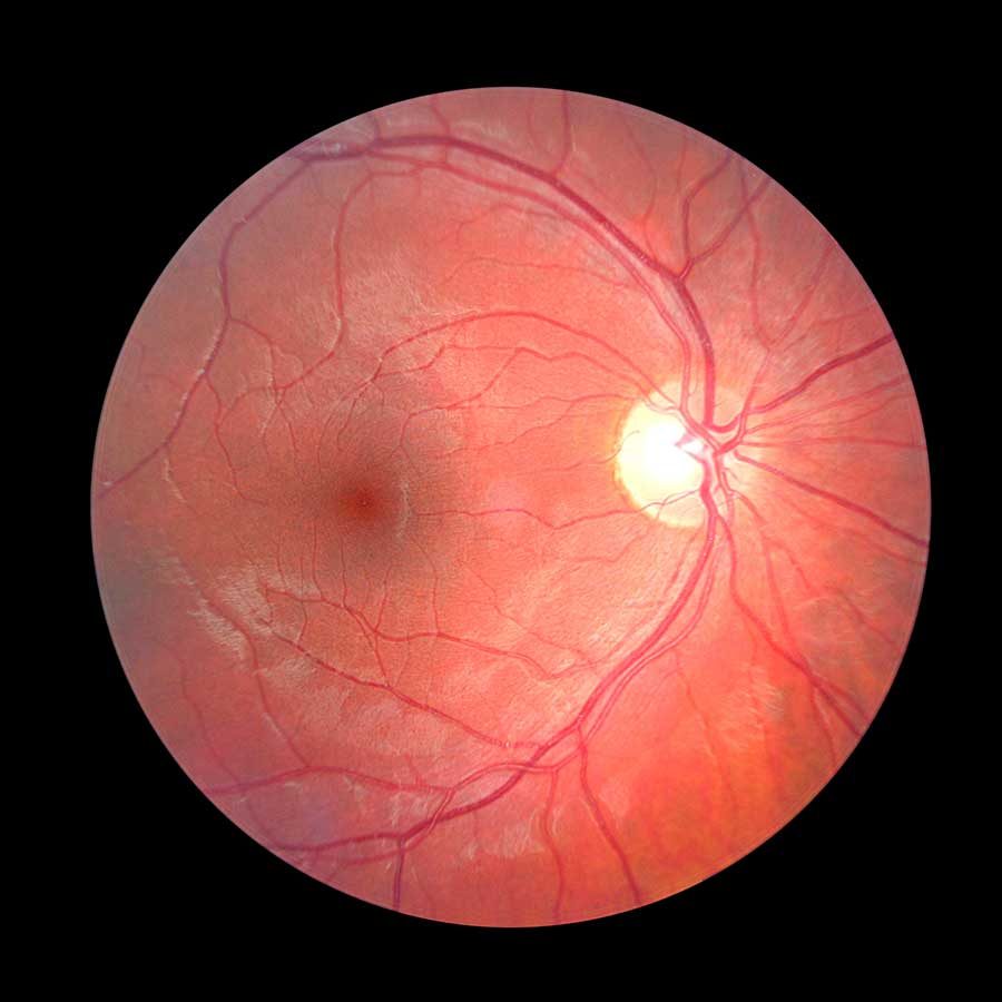 <p>Region at the back of the eye where the optic nerve meets the retina. It is the blind spot of the eye because it contains only nerve fibers, no rods or cones, and is thus insensitive to light.</p>