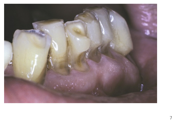 <ul><li><p><strong>Toothbrush abrasion:</strong></p><ul><li><p class="p1"><strong>Horizontal cervical notches on buccal surface</strong> of exposed radicular cementum &amp; dentin</p></li><li><p class="p1">Well-defined margins</p></li><li><p class="p1">Smooth, hard surface</p></li></ul></li><li><p class="p1"><strong>If acid is present: </strong>lesions become rounded &amp; shallower</p></li><li><p class="p1"><strong>Other manifestations: </strong>rounded or V-shaped notches on incisal edges of anterior teeth → associated causes: </p><ul><li><p class="p1">Thread biting</p></li><li><p class="p1">Use of pipes or bobby pins</p></li></ul></li></ul><p></p>
