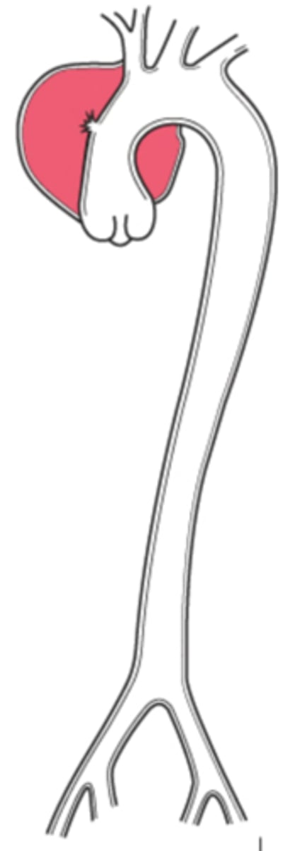 <p>involves ascending aorta</p>