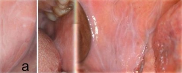 <p>Widespread, filmy white, wrinkled mucosa - Adherent.</p><p class="has-focus">Dissapears when stretched</p><p class="has-focus">First and second decades</p><p class="has-focus">No gender bias</p><p class="has-focus">More common in black children</p><p class="has-focus"><strong>Found on:</strong></p><p class="has-focus">Bilateral buccal mucosa</p><p class="has-focus">Labial mucosa</p><p class="has-focus">Soft palate</p>