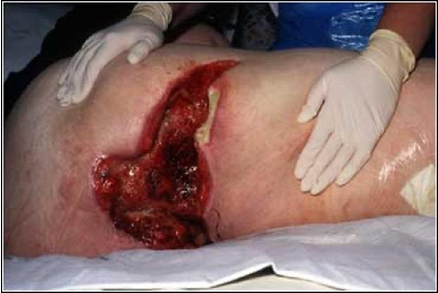 <p>Penetration through subcutaneous tissue exposing muscle and bone (tendon and joints)</p><p>Sinus tracts may be present</p><p>CAN BE LIFE threatening</p>