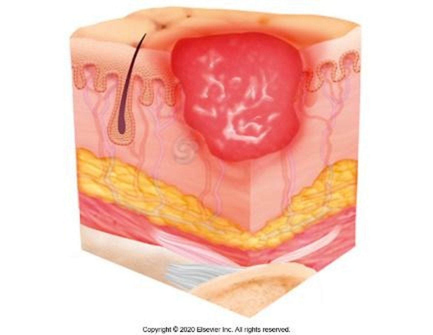 <p>Partial-thickness skin loss with exposed dermis; wound bed is viable, pink or red and moist.</p>