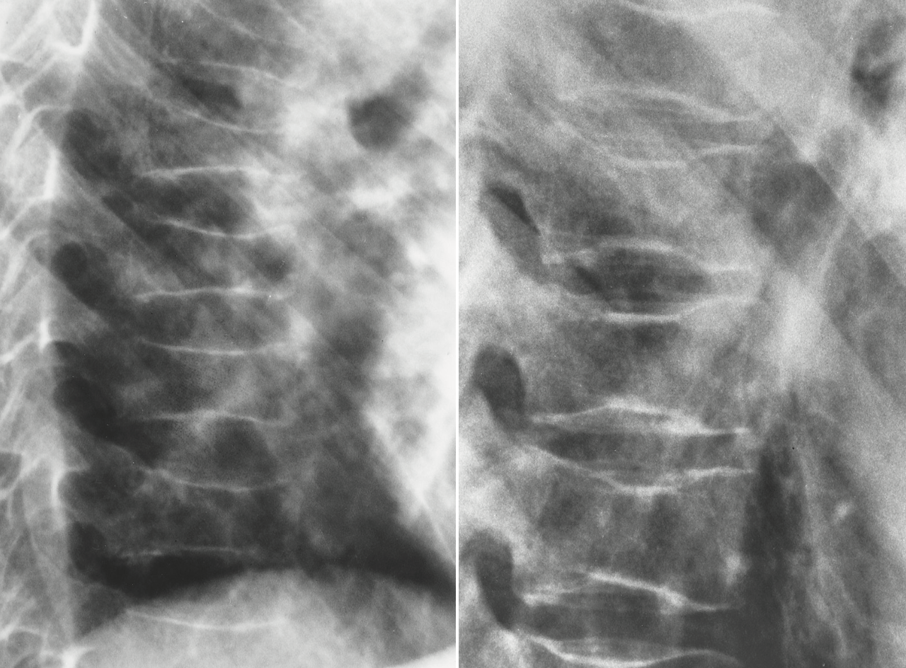 <p>sickle cell anemia appearance</p>