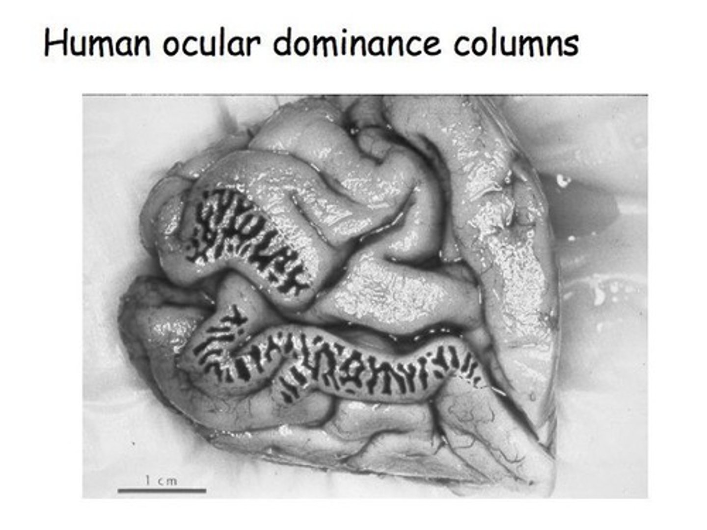 <p>In a patient who has lost an eye, only the neurons responding to the active eye are active, as seen in the dark stripes of a stained brain.</p>