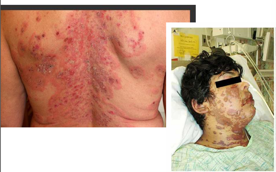 <ol><li><p>A life-threatening condition that can cause a painful rash, and<strong><mark data-color="yellow" style="background-color: yellow; color: inherit"><u> blistering of the skin a</u></mark></strong>nd mucus membranes that results in scarring of the ocular surface and lids</p></li><li><p>Immune complex–mediated hypersensitivity reaction caused by many agents </p><ol><li><p>• Medication </p></li><li><p>• Infections </p></li><li><p>• Auto immune conditions </p></li><li><p>• Idiopathic in 50% of cases</p></li></ol></li></ol><p></p>