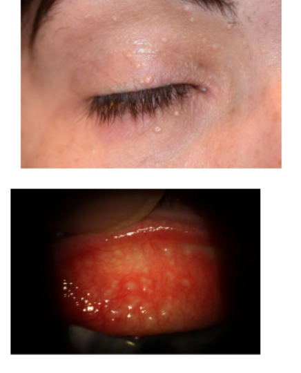 <p>mollescum contagiosm</p>