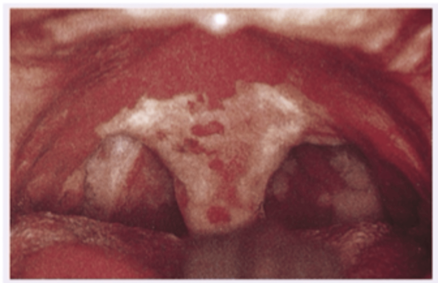<p>This patient is a 10 year old unvaccinated amish child with sore red throat, there is a gray red exudate as shown in the photo. The airway may become obstructed, so this is a life threatening bacterial infection. What is the diagnosis?</p><p>- Rubeola</p><p>- Kaposi's Sarcoma</p><p>- Diphtheria</p><p>- Thrush</p>