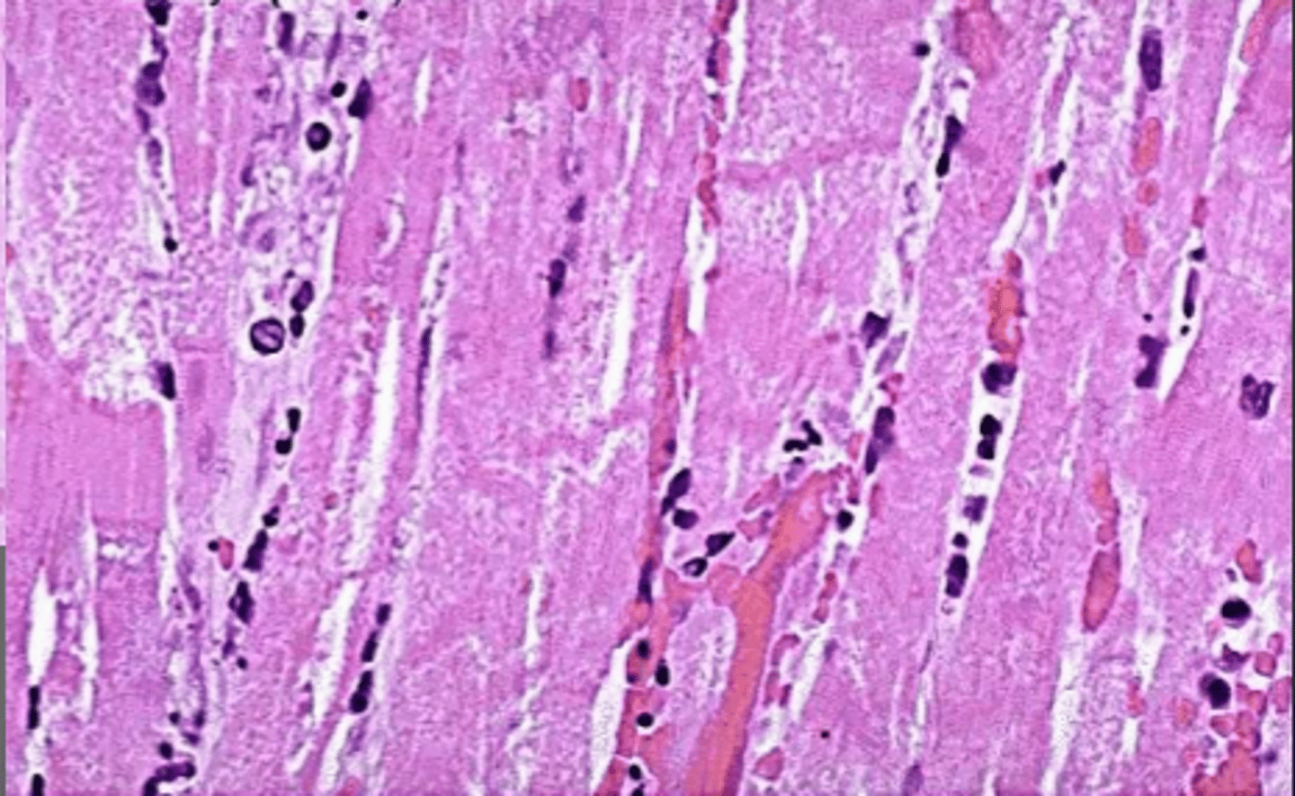 <p>What stage in myocardial necrosis is this section in?</p>